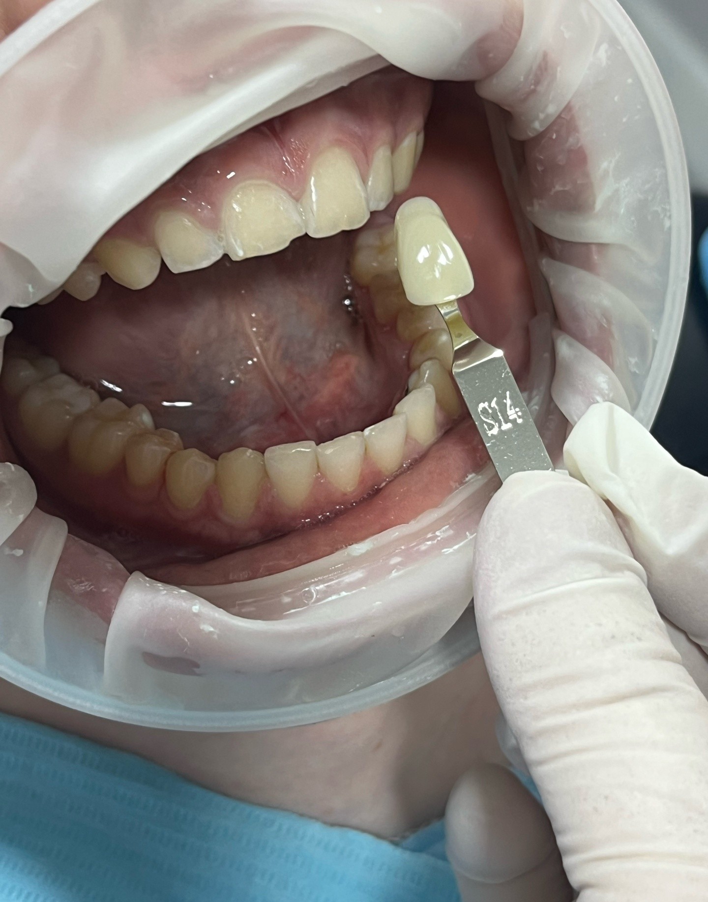 Implant_Stom