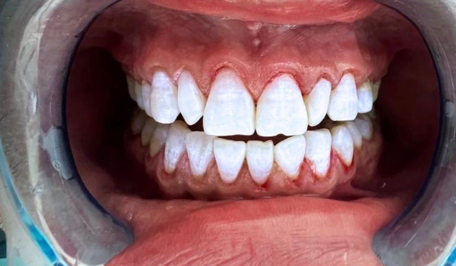 32 whitening room