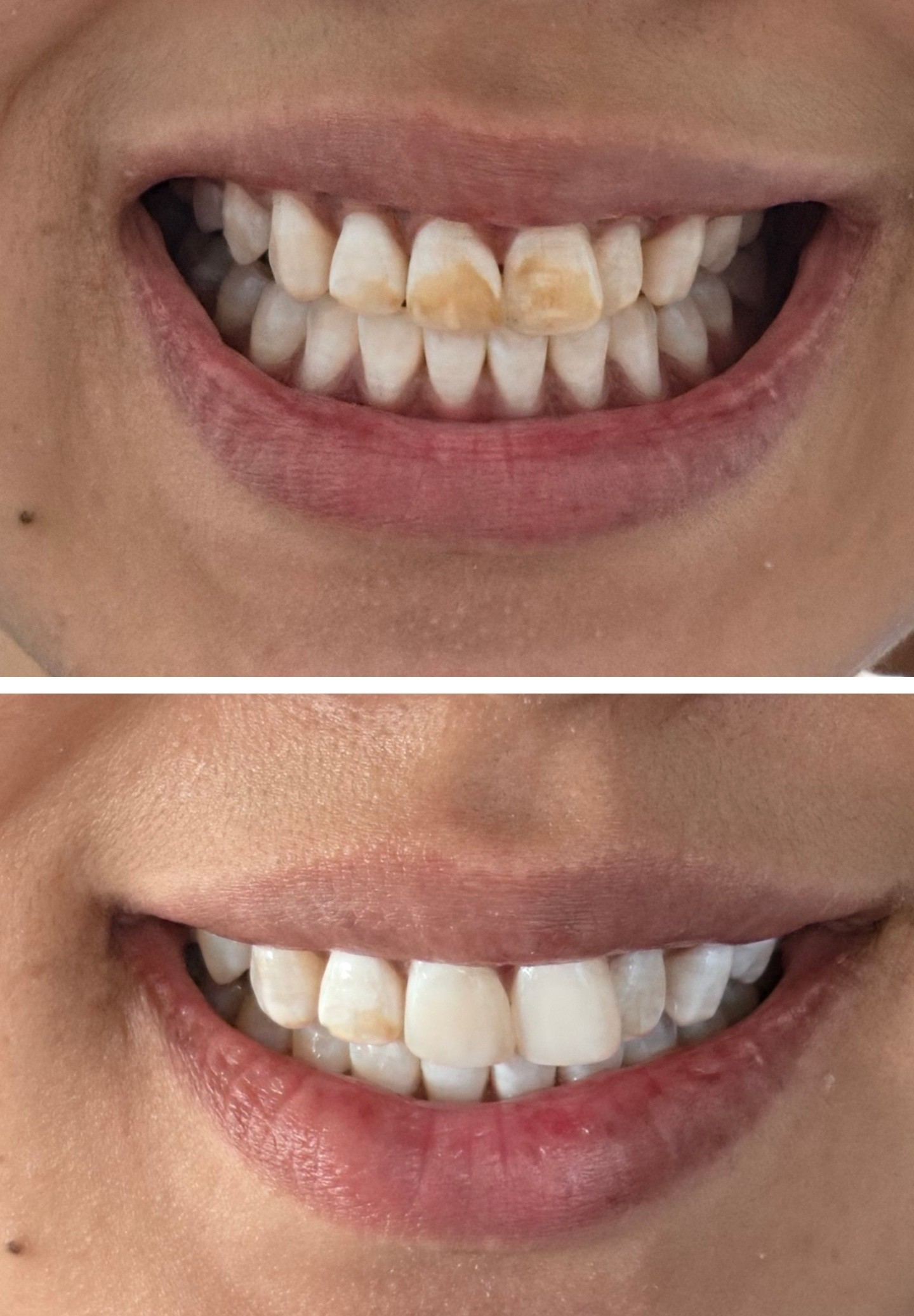 32 whitening room