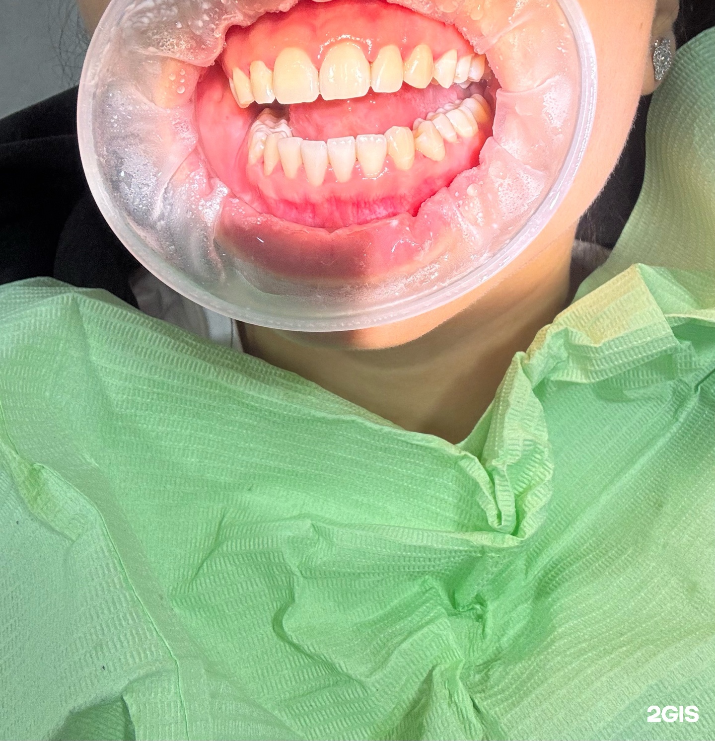 Zero Dent