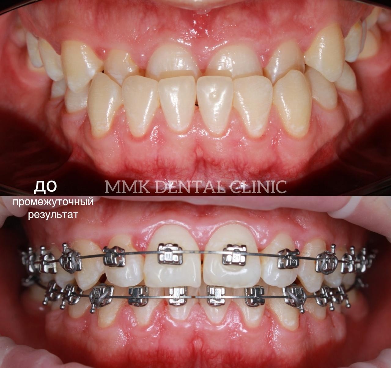 MMKDent